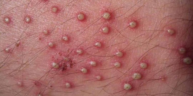 Nên trị viêm nang lông sớm khi phát hiện ra các triệu chứng