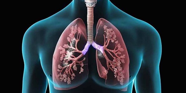 Nội tạng của bệnh nhân lao phổi