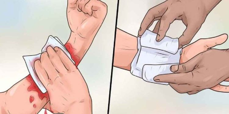 Hướng dẫn xử lý khi bị chó cắn để tránh bị dại