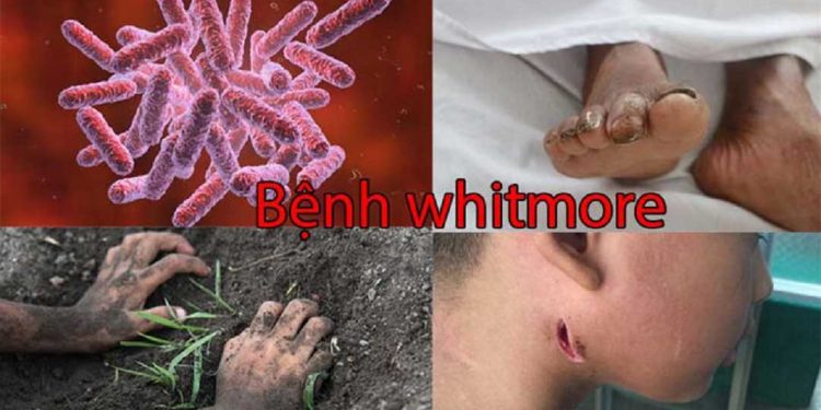 Triệu chứng khi mắc bệnh Whitmore
