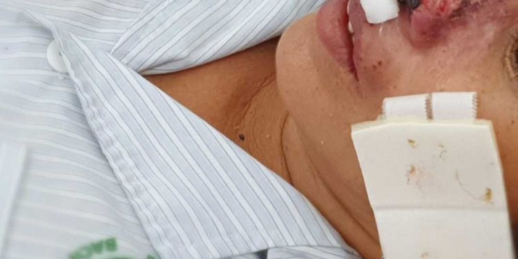 Phòng ngừa bệnh vi khuẩn ăn thịt người