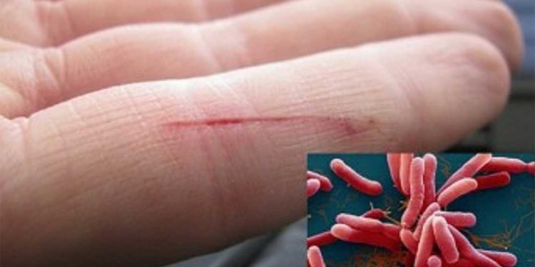 Vi khuẩn ăn thịt người sẽ xâm nhập vào cơ thể người qua các vết cắt, vết xước trên cơ thể