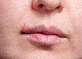 Nguyên nhân gây bệnh herpes môi
