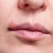 Nguyên nhân gây bệnh herpes môi