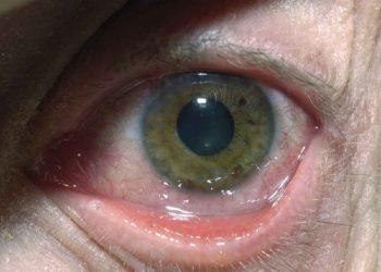 Virus herpes là gì?