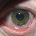 Virus herpes là gì?