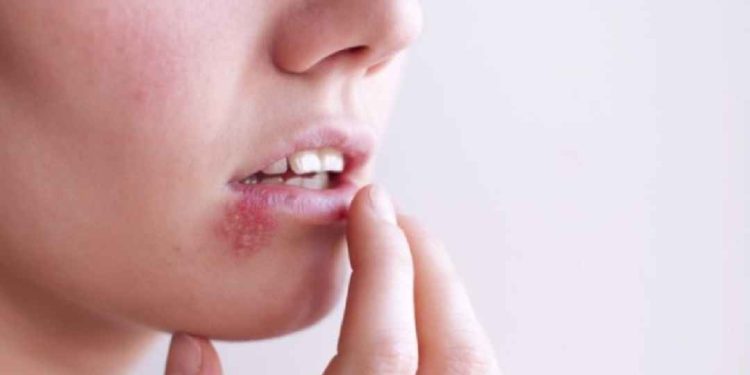 Triệu chứng bệnh do HSV gây ra