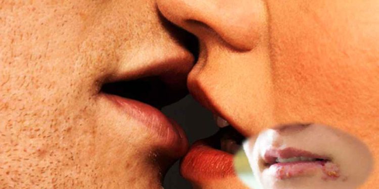 Virus HSV lây qua đường nào?