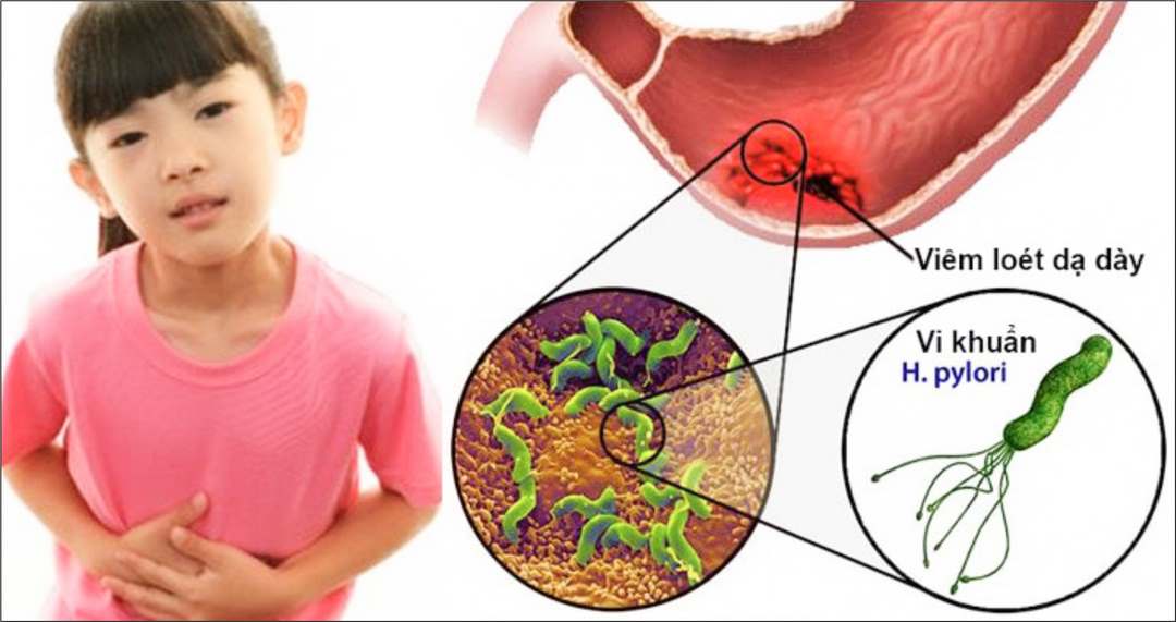 Các biện pháp điều trị nhiễm vi khuẩn HP