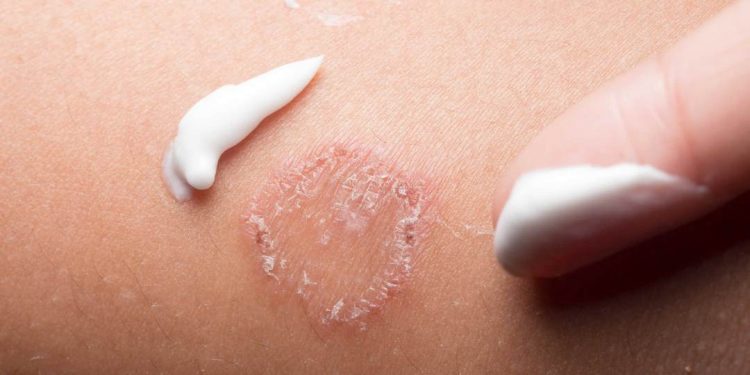 Bệnh hắc lào là bệnh do các loại vi nấm gây ra