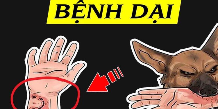 Cách nhận biết bệnh dại ở người theo từng thời kỳ