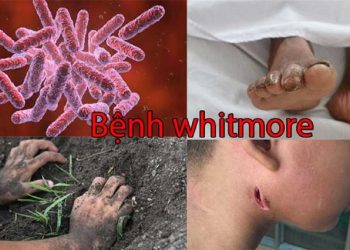 Triệu chứng khi mắc bệnh Whitmore