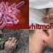 Triệu chứng khi mắc bệnh Whitmore