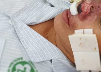 Phòng ngừa bệnh vi khuẩn ăn thịt người