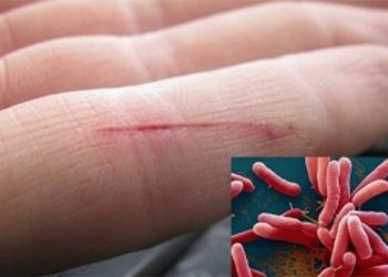 Vi khuẩn ăn thịt người sẽ xâm nhập vào cơ thể người qua các vết cắt, vết xước trên cơ thể