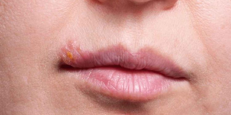 Nguyên nhân gây bệnh herpes môi