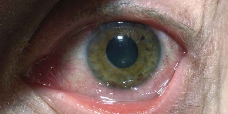 Virus herpes là gì?